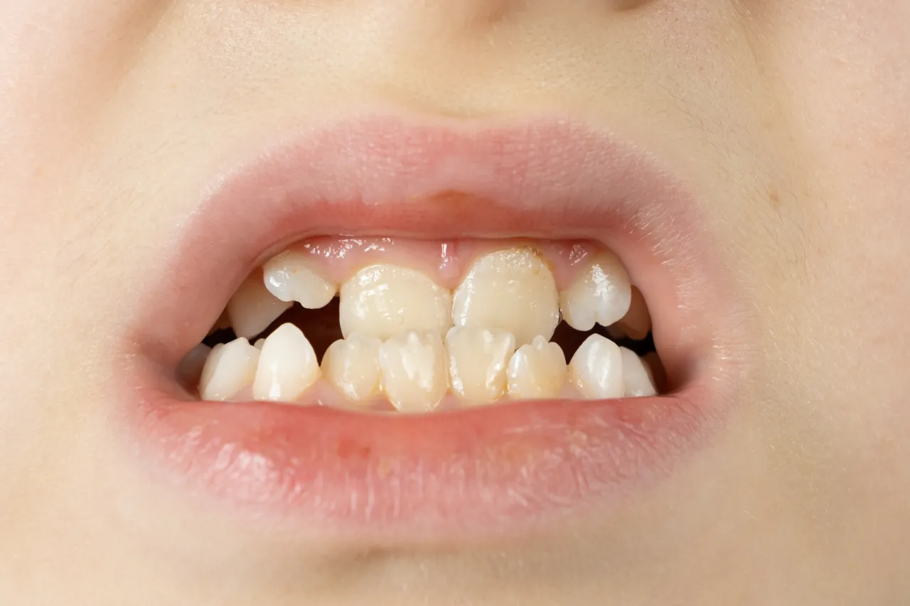 Child with dental crowding affecting the alignment of the teeth